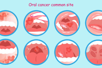 Oral-Cancer TaazaDaily365