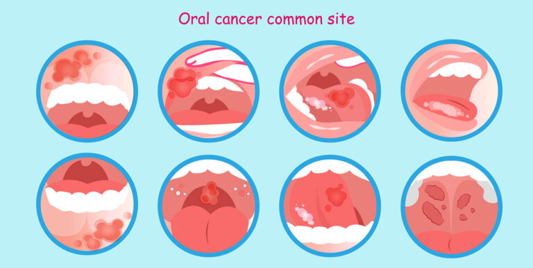Oral-Cancer TaazaDaily365